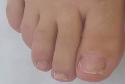 Brand fung mycosis quickly got rid of