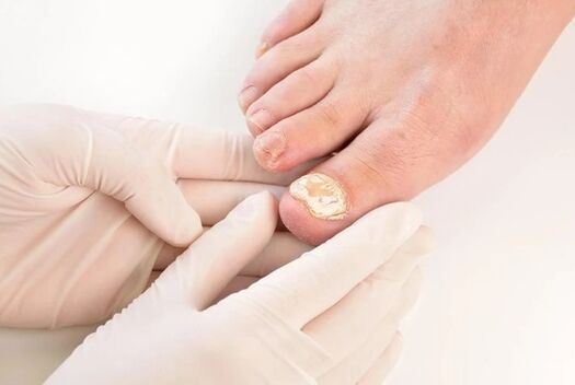 Doctors recommend brand fun fire for the treatment of mycoses