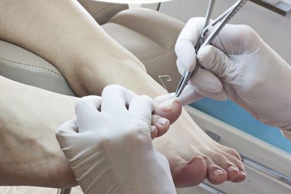 Mechanical removal of nails affected by mushroom