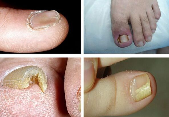 Symptoms of onychomycosis on the legs