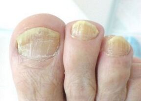 Nail fungus