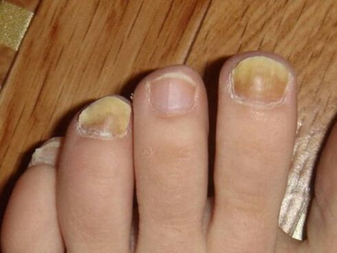 Fungus on feet with nail damage
